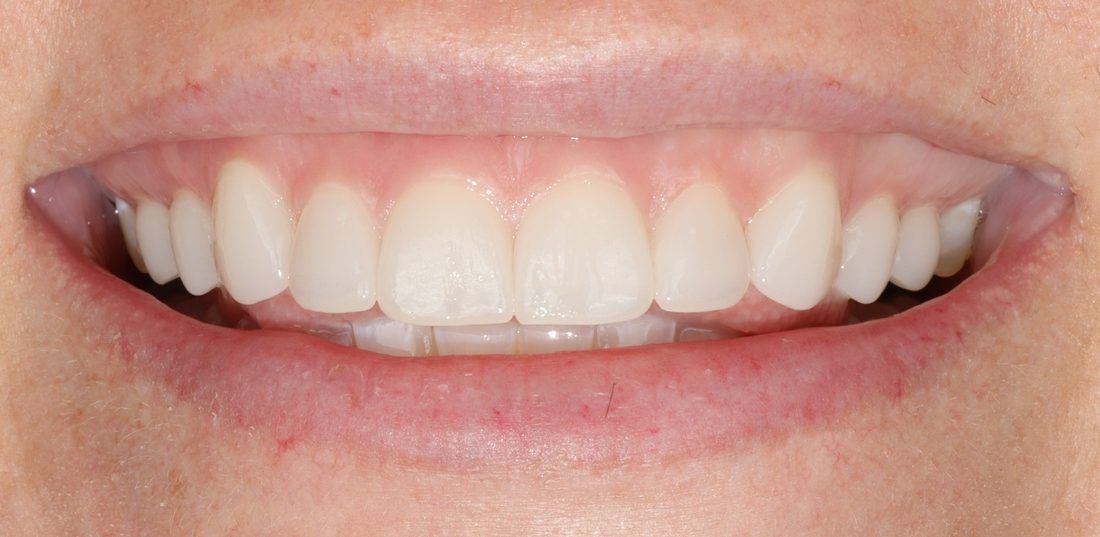 Porcelain veneers — after (actual patient)
