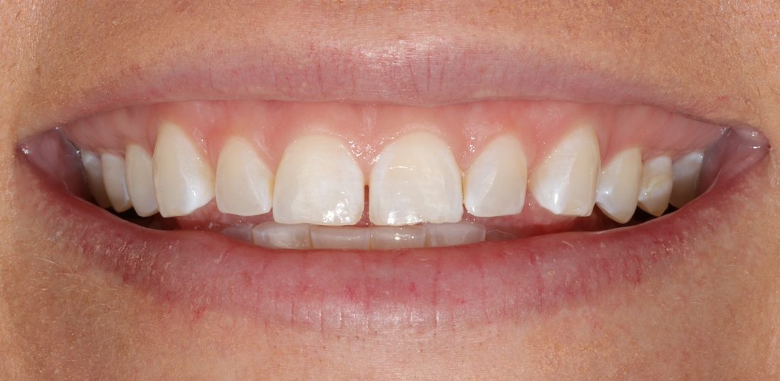 Porcelain veneers — before (actual patient)