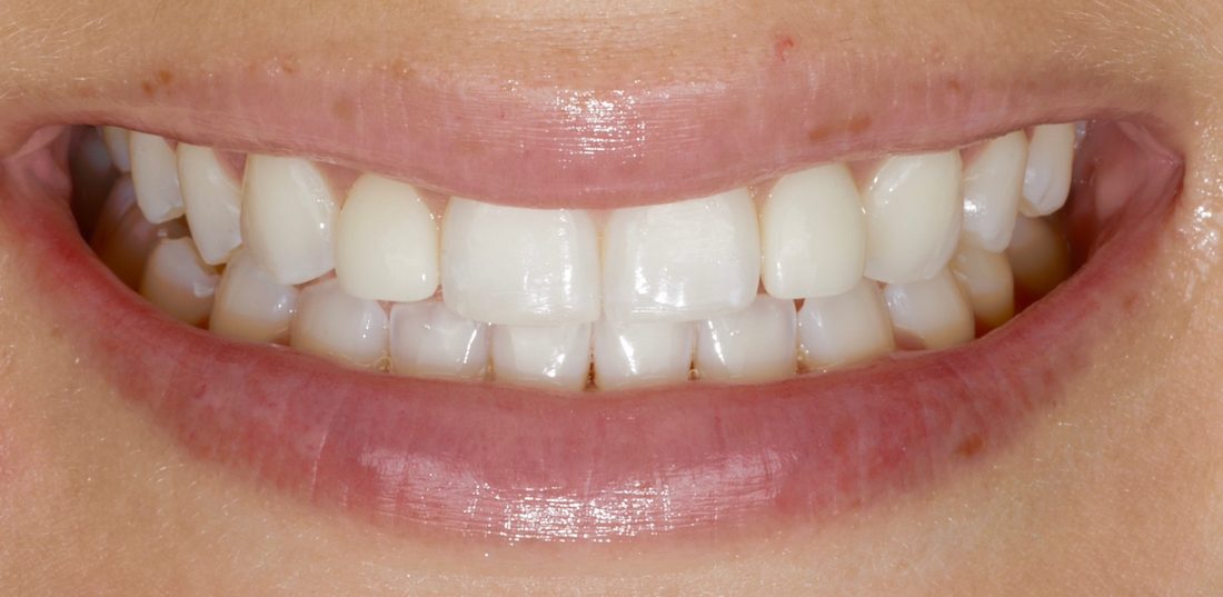 2 Implants — after (actual patient)