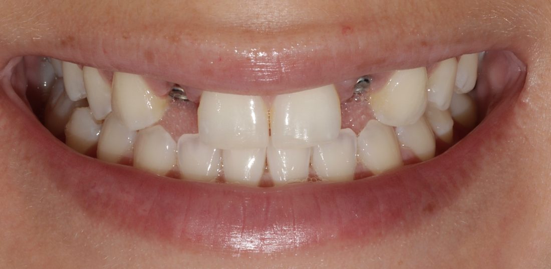 2 Implants — before (actual patient)