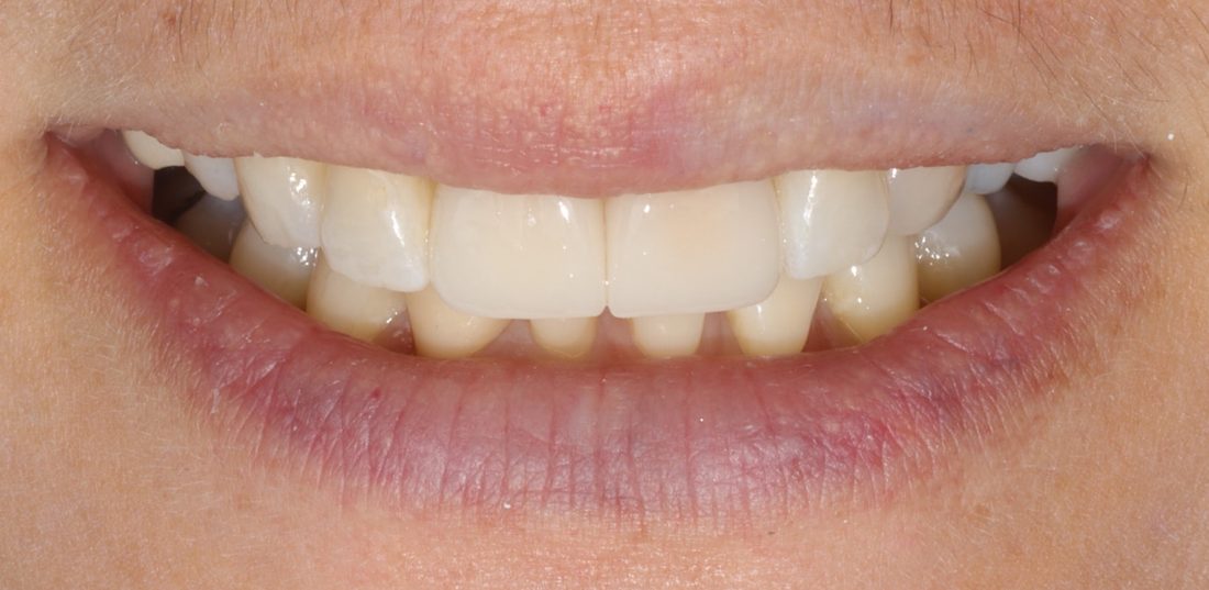 2 Porcelain Veneers — after (actual patient)
