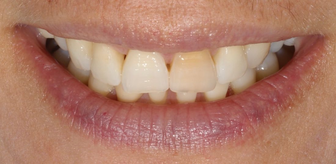 2 Porcelain Veneers — before (actual patient)