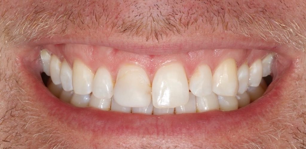 4 Porcelain Veneers — before (actual patient)