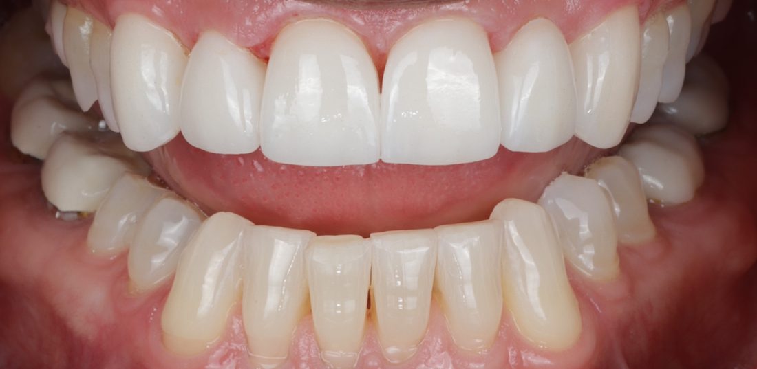 6 Porcelain Veneers — after (actual patient)
