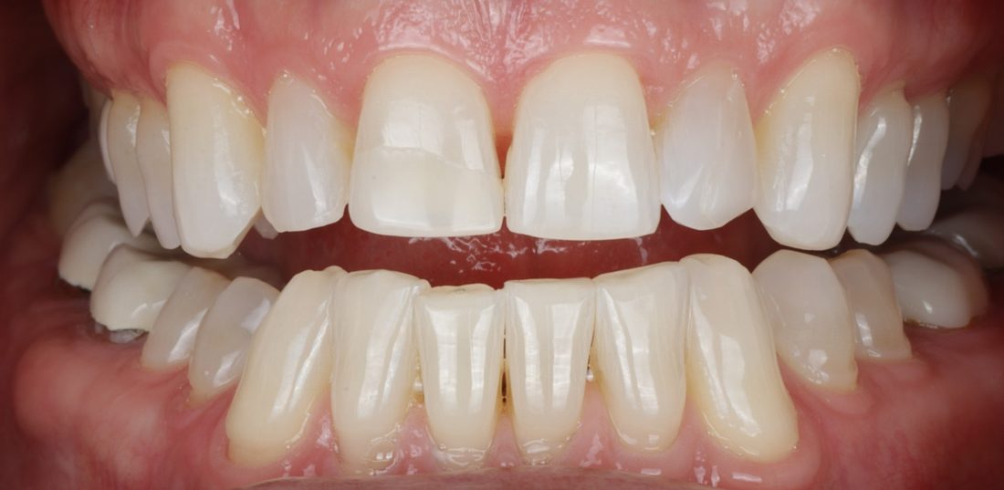 6 Porcelain Veneers — before (actual patient)