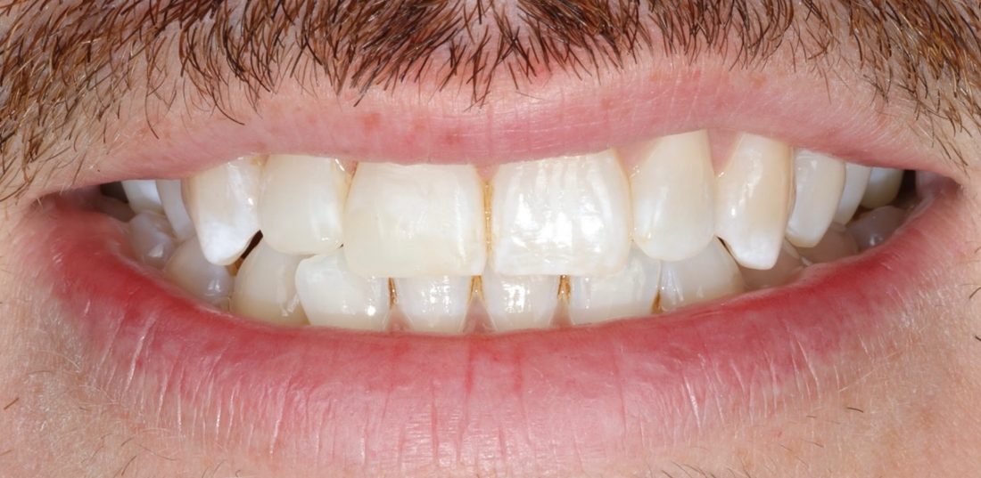Composite Bonding — after (actual patient)