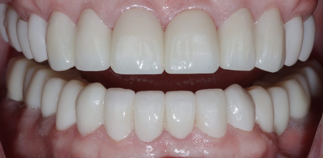 Full-mouth restoration result — actual patient