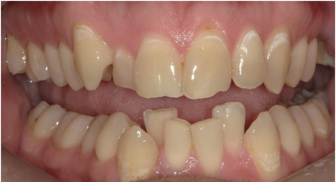 Invisalign and 4 Veneers — before (actual patient)