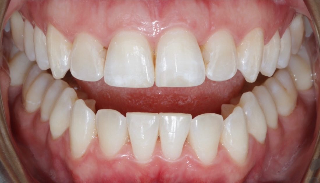 Invisalign and Whitening 2 — after (actual patient)