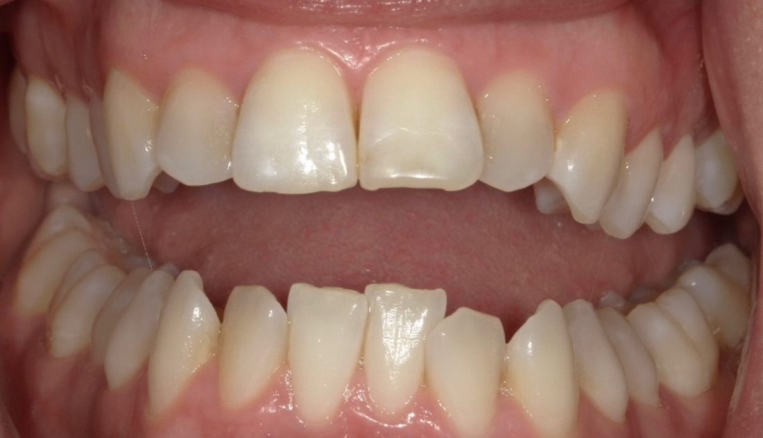 Invisalign and Whitening 2 — before (actual patient)