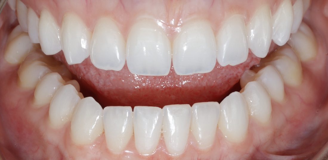 Invisalign and Whitening 3 — after (actual patient)