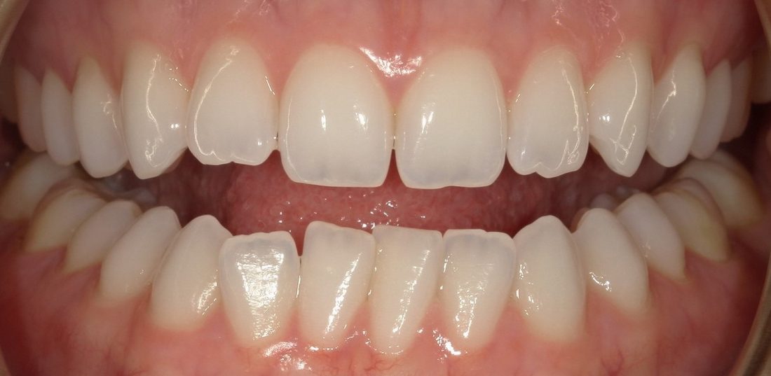 Invisalign and Whitening 3 — before (actual patient)