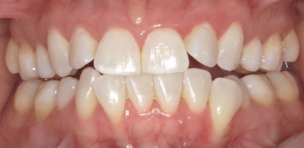 Invisalign and Whitening — before (actual patient)