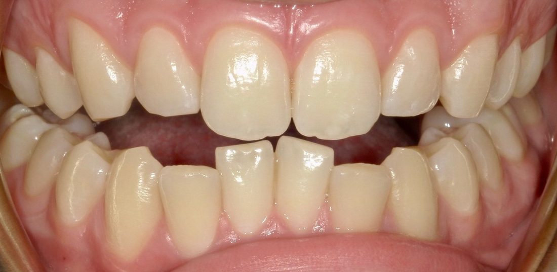 Invisalign — before (actual patient)