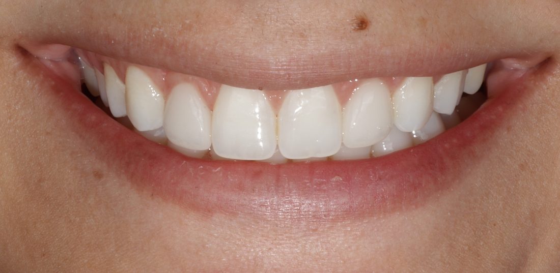 Peg Laterals — after (actual patient)