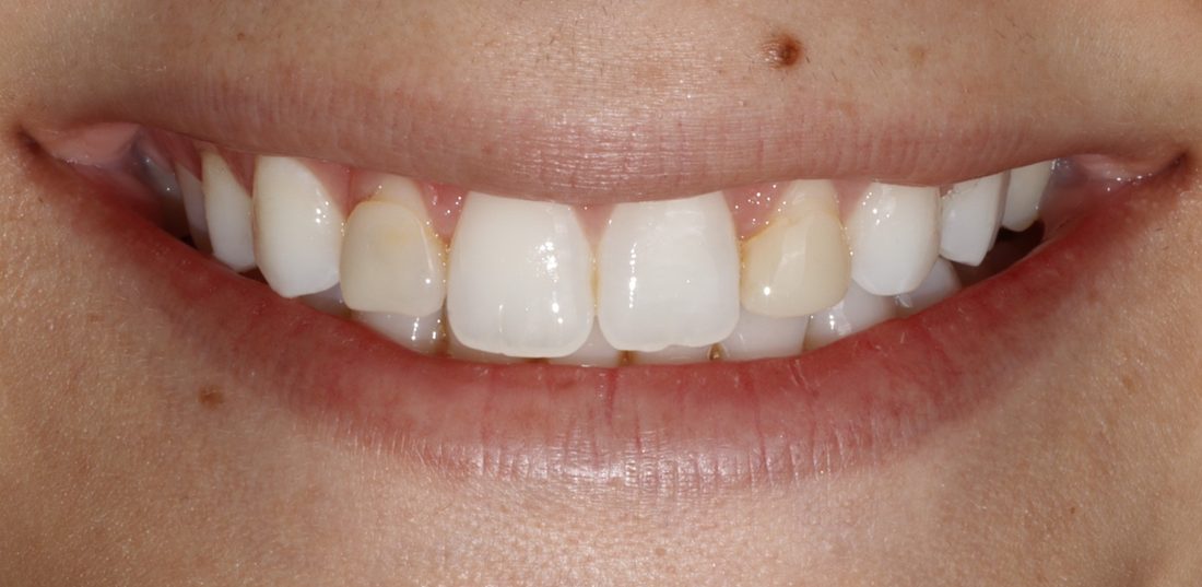 Peg Laterals — before (actual patient)