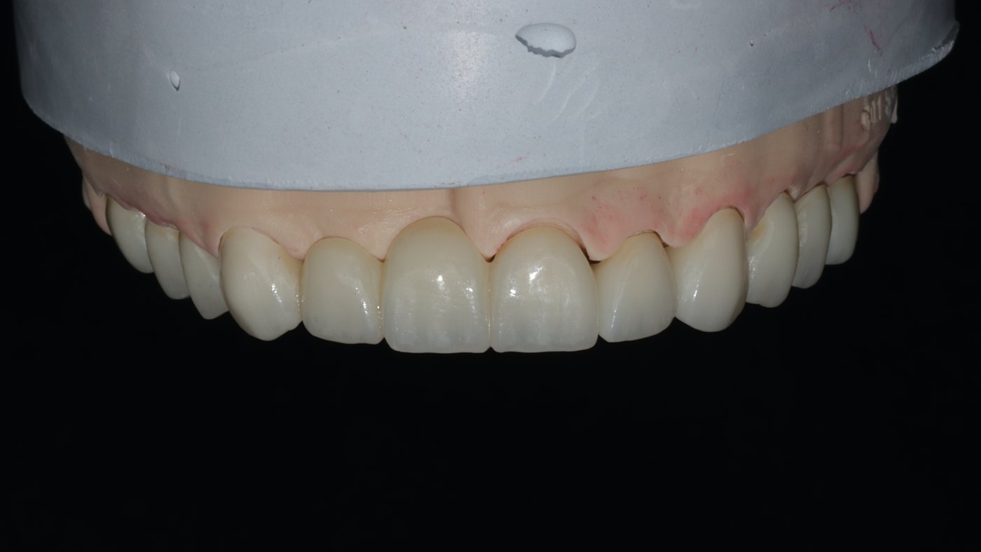 Full-arch fixed restoration