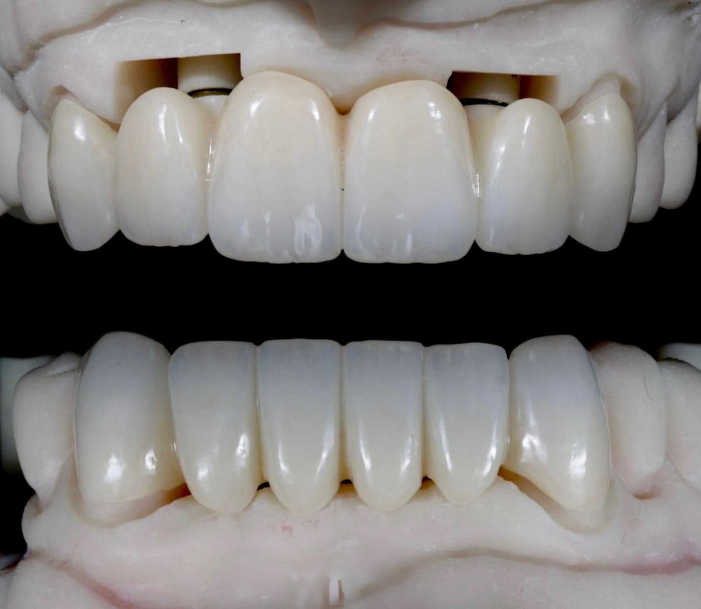 Handcrafted porcelain implant restoration