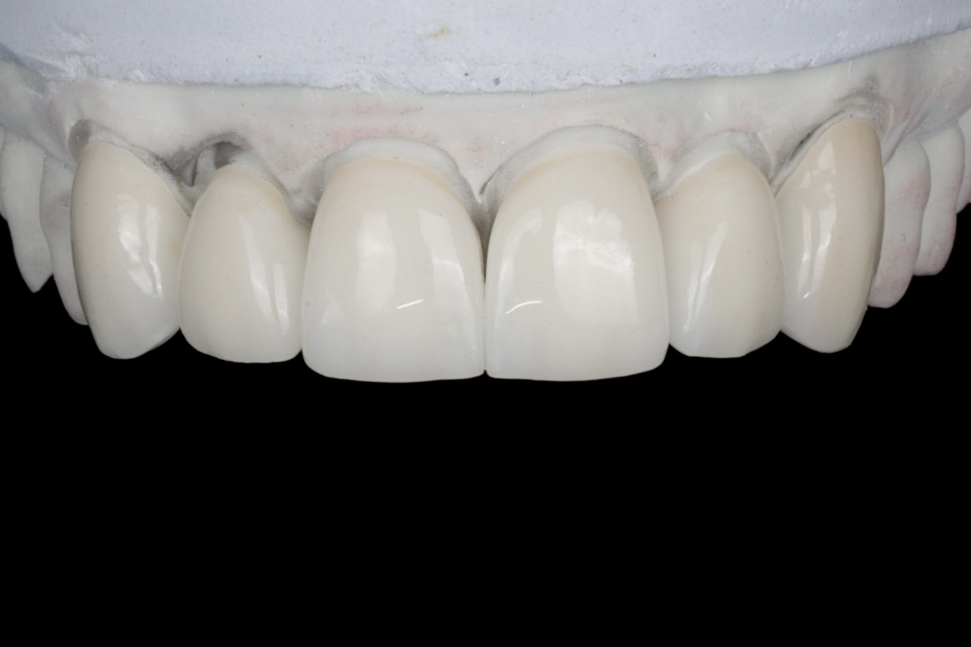 Handcrafted porcelain restoration